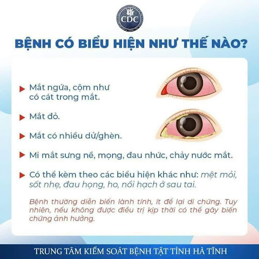 đau mắt đỏ 3