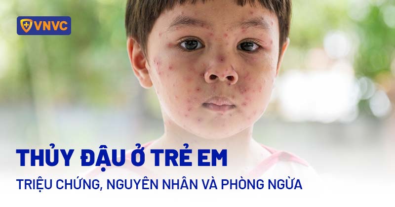 Bài tuyên truyền cách phòng, chống bệnh Thuỷ đậu