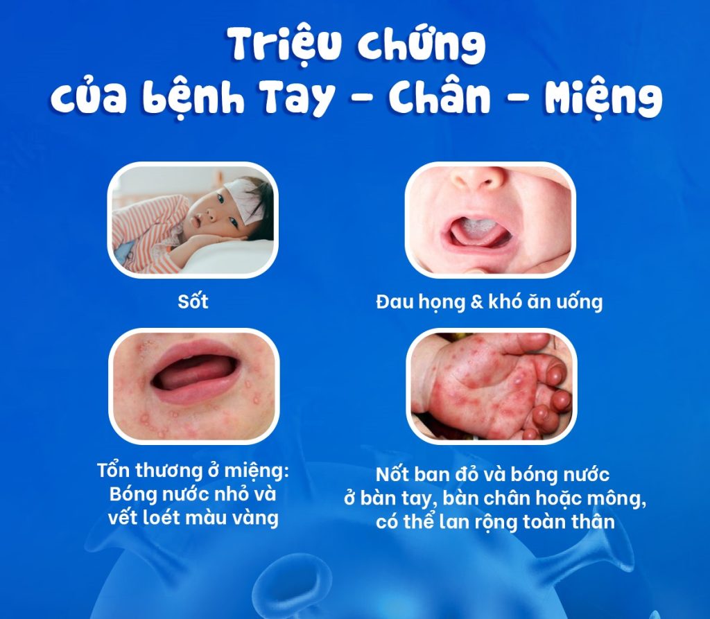 benh tay chan mieng 2 1024x893